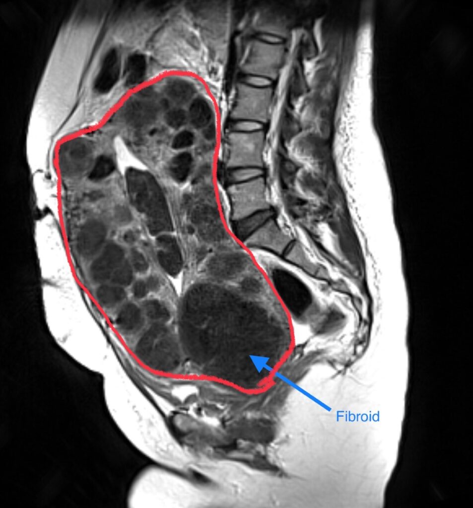 Impending fibroid expulsion on MRI after uterine fibroid